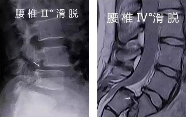 惊！25岁姑娘弯腰竟骨折，医生一句话让她瞬间崩溃……